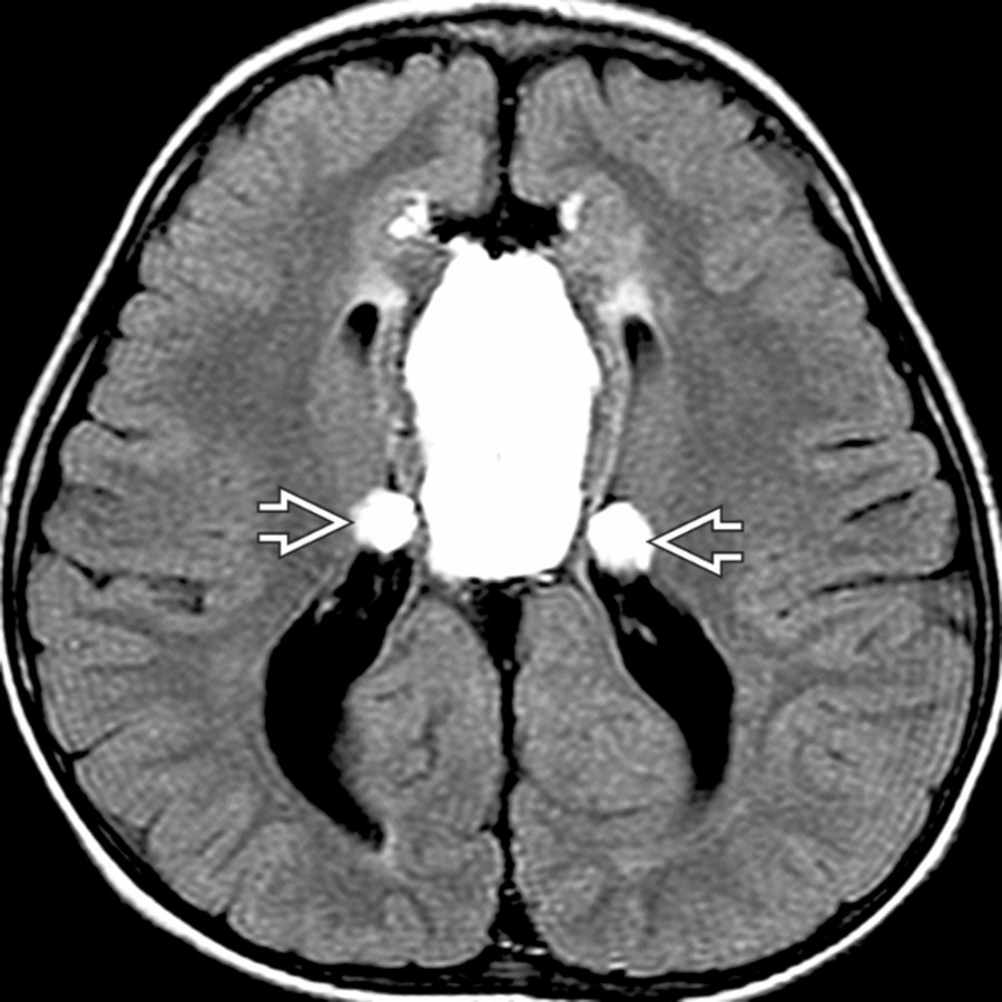 Axial FLAIR MR shows a large midline lipoma. Two smaller lipomatous masses  protrude into the lateral ventricles.