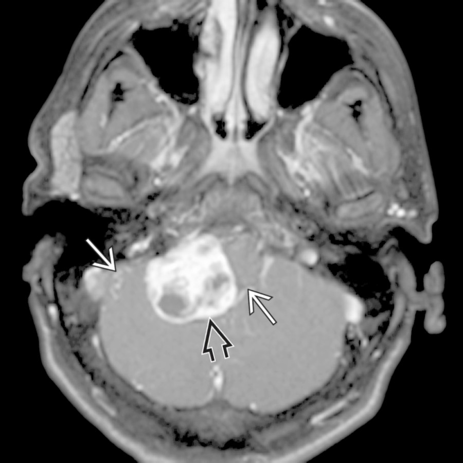 Axial T1 C+ FS MR shows a mixed, solid, cystic enhancing mass in the cerebellum . Note the enlarged vessels , suggesting hypervascularity. A solid/mixed solid lesion with intratumoral cysts is less common than classic hemangioblastoma (a nodule and nonenhancing cyst).