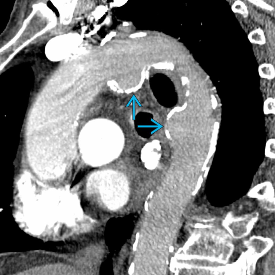 Oblique sagittal chest CECT in the same patient shows 2 saccular aneurysms   with rather extensive atherosclerotic changes of the thoracic aorta.