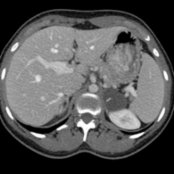 Axial CECT in a 28-year-old woman with abdominal pain shows an incidental left adrenal cystic lesion . Note thin cyst septation , a finding characteristic of endothelial adrenal cyst.