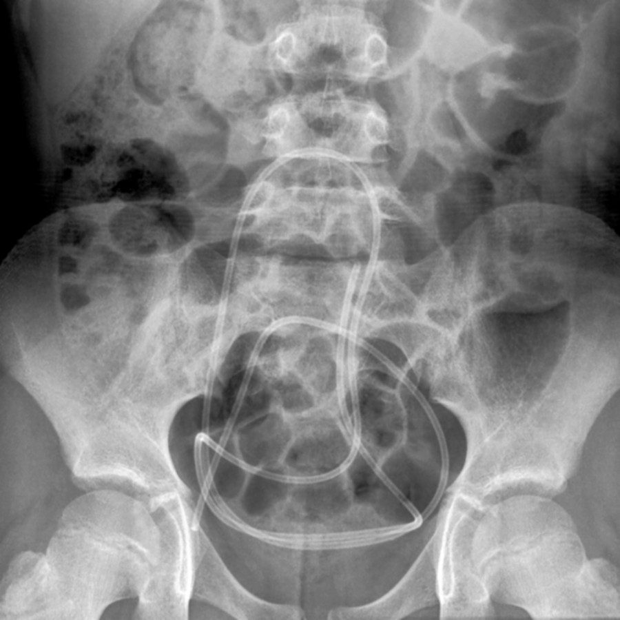 AP radiography shows a disconnected and caudally migrated peritoneal shunt catheter fragment looped within the pelvis.