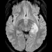Axial FLAIR MR in a patient who presented with altered sensorium demonstrates a large hyperintense lesion in the left medial temporal lobe .