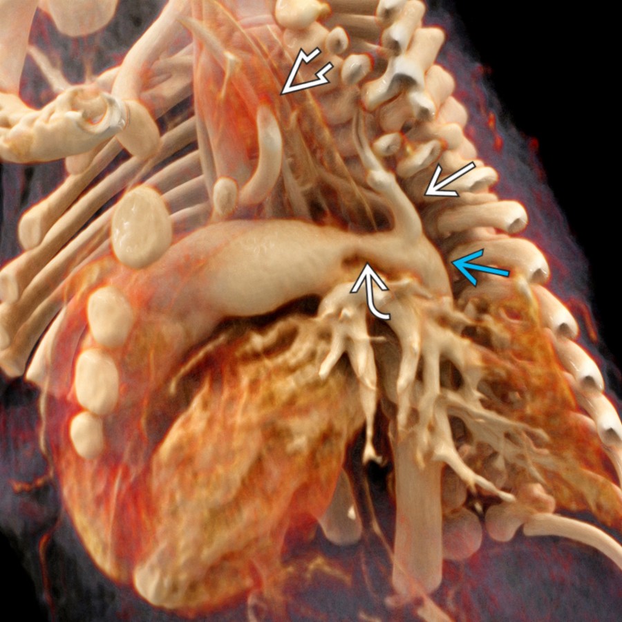 CTA cinematic rendering demonstrates type B IAA. The LSA  originates from the DA . The BCT and LCC  originate from the proximal ascending aorta (AA). The PDA  provides blood flow to both the LSA and DA.