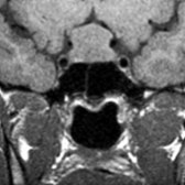 Coronal T1 MR shows a sellar/suprasellar mass in a 42-year-old man with diabetes insipidus. Note the "figure of 8" configuration identical to macroadenoma. Biopsy proved LH.