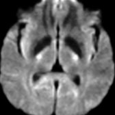 Axial DTI trace image shows symmetric hyperintensity in the internal capsule posterior limbs . FA correlates with measures of disease severity and UMN involvement, whereas the MD correlates with disease duration.