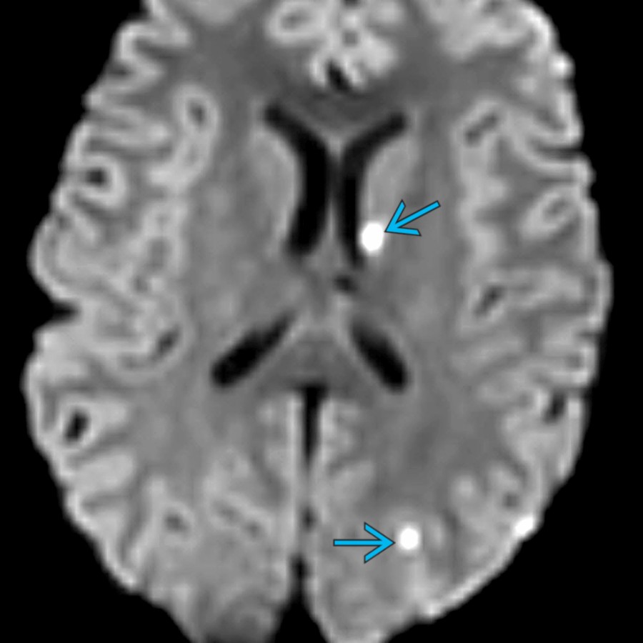Axial DWI MR in a 16-year-old boy involved in a motor vehicle collision (MVC) shows multiple small foci of diffusion restriction , consistent with small infarcts. Multiple infarcts should raise concern for dissection, especially when confined to a single arterial territory.