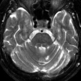 Axial T2 MR in the same patient shows volume loss with enlarged horizontal sulci in the contralateral cerebellar hemisphere . These findings are consistent with chronic CCD.