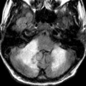 Axial FLAIR MR shows asymmetric, flocculent, nearly confluent, hyperintense lesions of acute disseminated encephalomyelitis within posterior fossa structures.