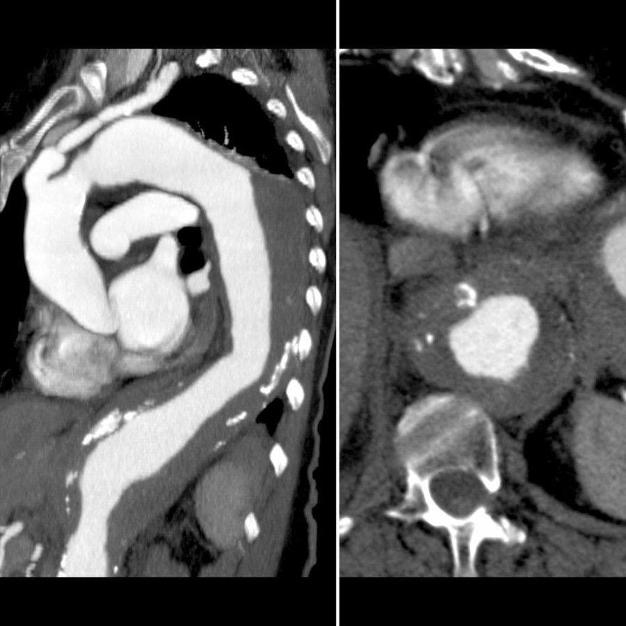 Parasagittal (left) and coronal oblique (right) images through the aorta in a 79-year-old show diffuse fusiform atherosclerotic aneurysm of the DTA with extensive layering mural thrombus with areas of calcification due to degenerative changes. The maximum aortic diameter was 6.8 x 6.3 cm. The AA is normal.