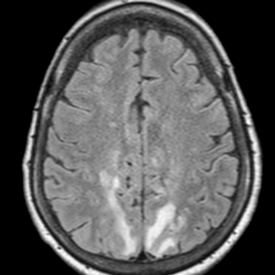 Axial FLAIR MR shows bilateral T2 hyperintensity in the parietal lobe cortex and subcortical white matter. In this patient with malignant hypertension, PRES was suspected.