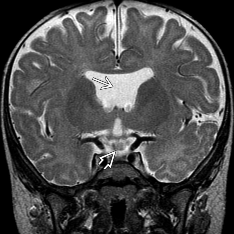 Coronal T2 MR shows absence of the septum pellucidum  and thinning of the pituitary infundibulum . Other midline defects of septo-optic dysplasia not shown here include optic nerve hypoplasia and ectopic posterior pituitary.