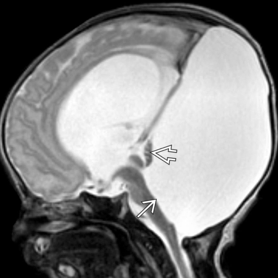 Sagittal T2 MR demonstrates a markedly enlarged posterior fossa with cystic dilatation of the 4th ventricle , upward rotation of severely hypoplastic vermis , markedly enlarged posterior fossa, and elevated torcula.