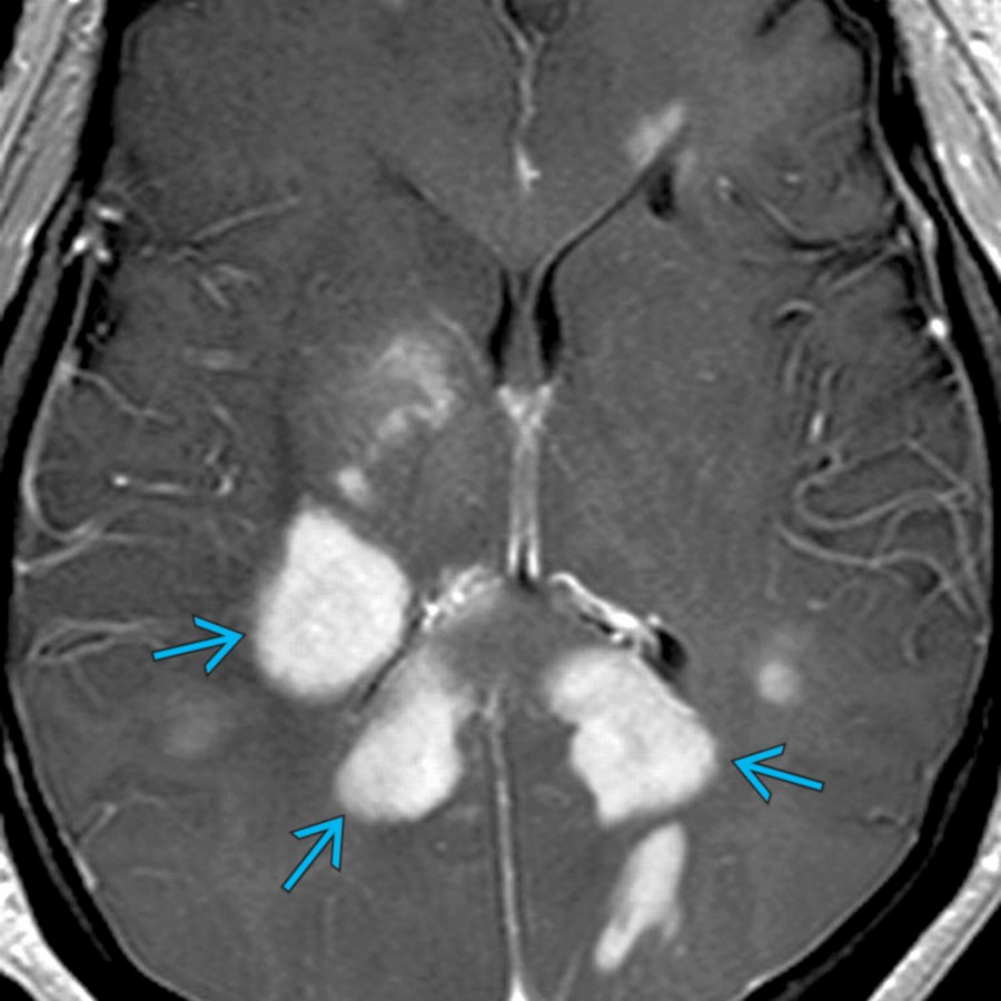 Axial T1 C+ MR in a young male with rapid onset of visual disturbance demonstrates large enhancing demyelinating lesions  in the deep and periventricular WM. Marburg disease is an acute fulminant MS variant.
