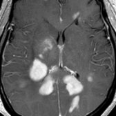 Axial T1 C+ MR in a young male with rapid onset of visual disturbance demonstrates large enhancing demyelinating lesions  in the deep and periventricular WM. Marburg disease is an acute fulminant MS variant.