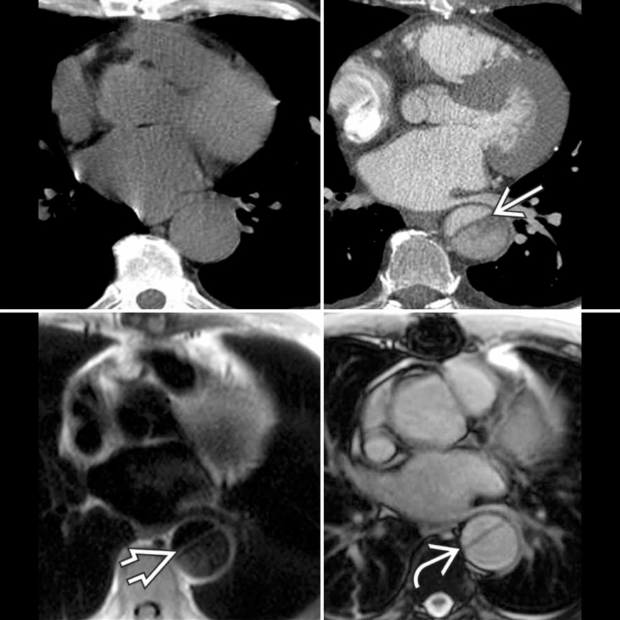 Axial NECT, CTA, and MR in a patient with type B aortic dissection are shown. The aortic dissection  is not seen on NECT. Axial unenhanced MR shows aortic dissection on HASTE (dark blood)  and SSFP (bright blood) , an advantage over NECT.