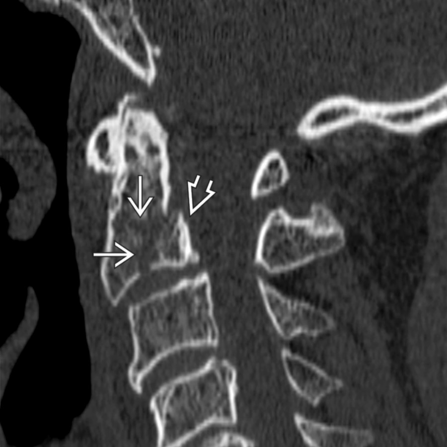 Sagittal NECT shows horizontal and vertical fractures of C2  due to axial load injury. The posterior fragment can displace posteriorly and cause cord compression .