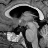 Sagittal T1 MR demonstrates a bright ectopic posterior pituitary gland  in a patient with septo-optic dysplasia. Note the small optic chiasm  and the low location of the fornices .