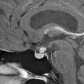 Sagittal T1 C+ MR in a 36-year-old woman with diabetes insipidus shows marked thickening and enhancement of the pituitary stalk  related to autoimmune LH. Absence of the posterior pituitary bright spot was also present.