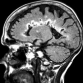Sagittal FLAIR MR shows MS plaques with hyperintense rim and central hypointensity (latter also hypointense on T1WI; not shown). Note the characteristic posterior fossa lesion .