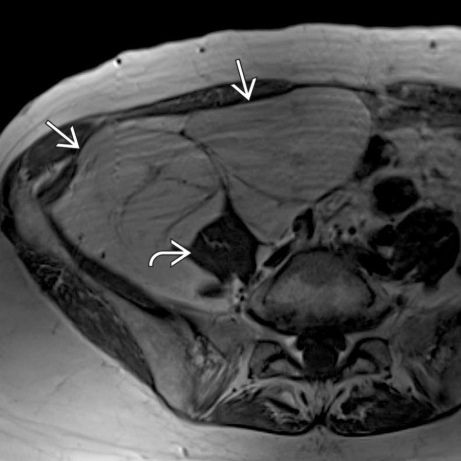 Axial T1 MR shows a large, fat-containing mass  occupying much of the right hemipelvis, with the right left psoas muscle  appearing stretched and distorted as a result of the retroperitoneal tumor. This was found to be a well-differentiated liposarcoma at resection.