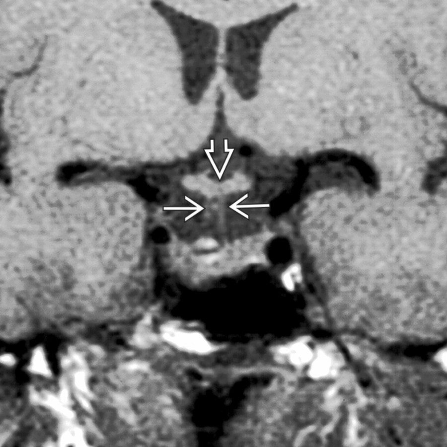 .Coronal T1 MR shows thinned, duplicated infundibular stalks  and thickening of the tuber cinereum .