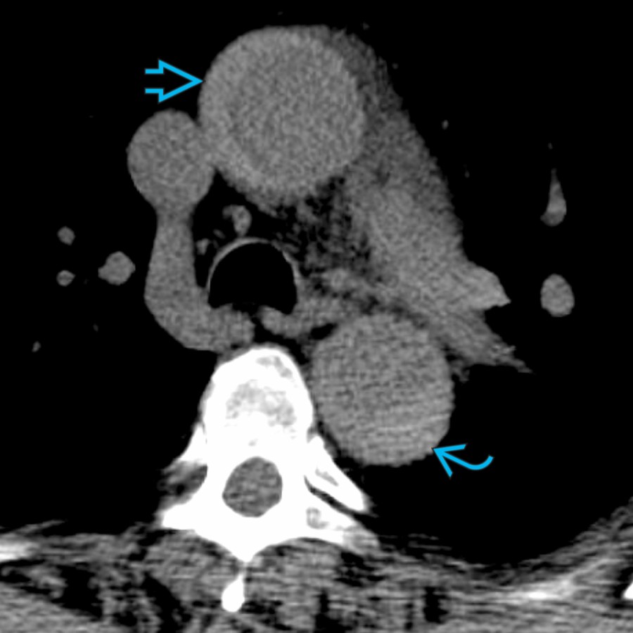 Axial NECT in a patient with Stanford type A intramural hematoma (IMH) shows crescent-shaped wall hyperdensity at the ascending  and descending  aorta.