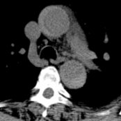 Axial NECT in a patient with Stanford type A intramural hematoma (IMH) shows crescent-shaped wall hyperdensity at the ascending  and descending  aorta.
