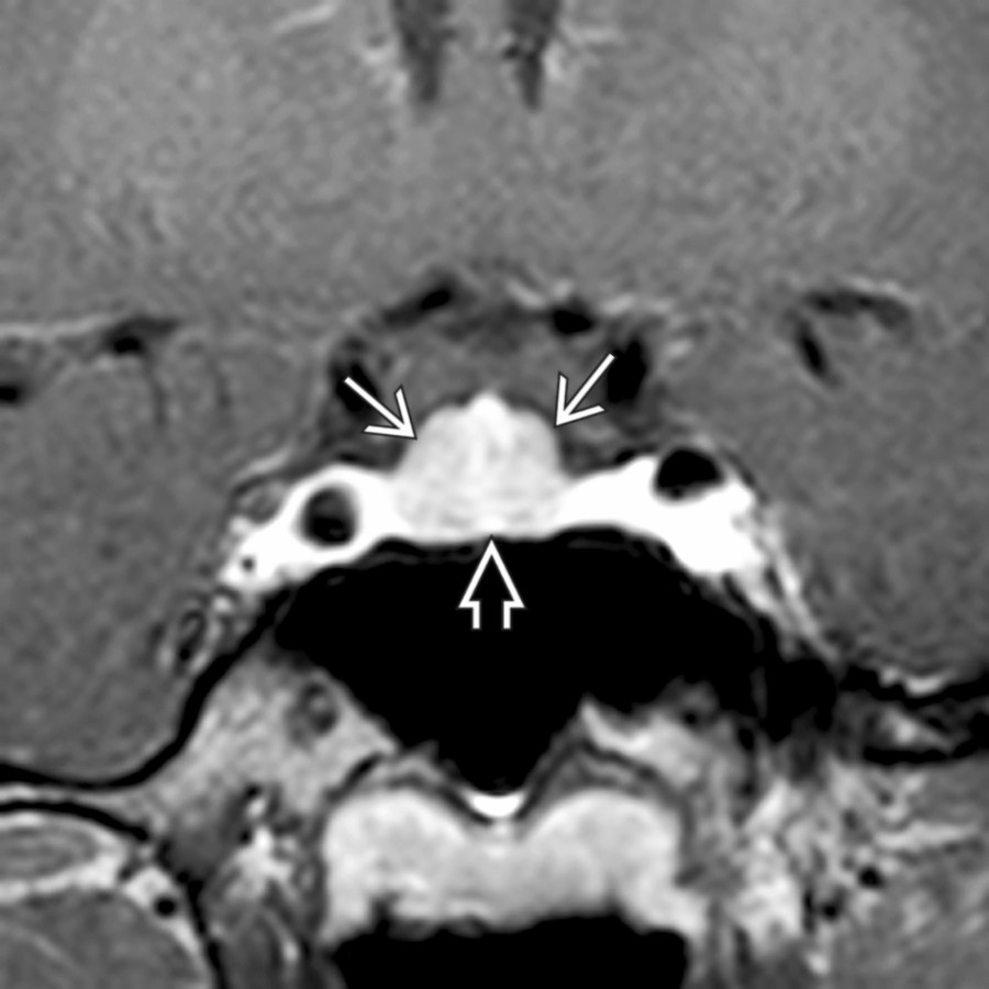 Coronal T1 C+ MR shows a flat, shallow sella turcica  causing upward bulging of the pituitary gland . Gland height measured 9 mm, normal in this young woman.
