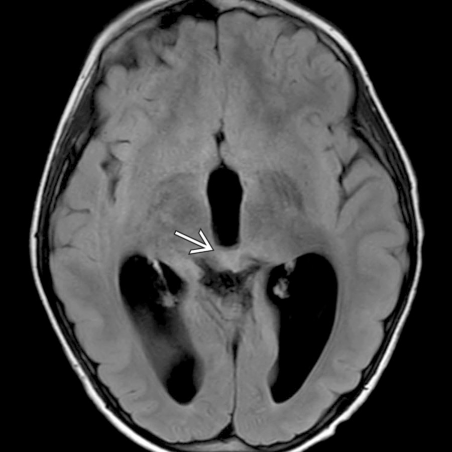 An infiltrating tectal glioma  obstructs the cerebral aqueduct in this 10-year-old. Absence of transependymal edema suggests a compensated hydrocephalus.