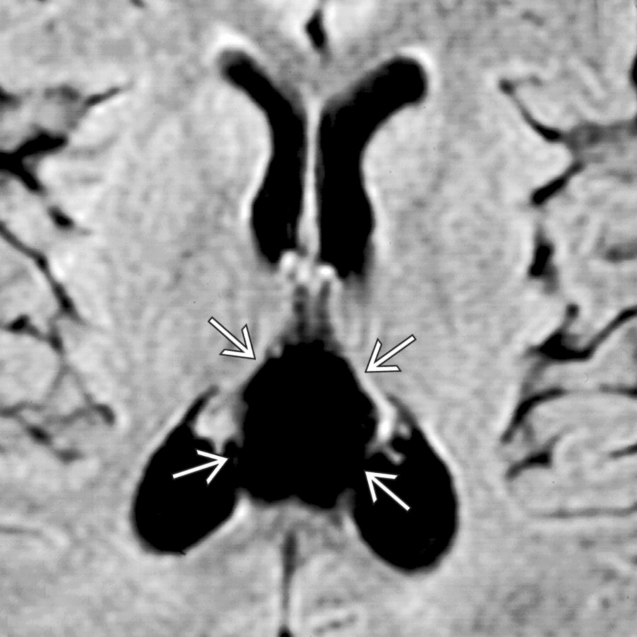 Axial FLAIR MR shows a cavum velum interpositum as a CSF isointense mass , which suppresses completely on FLAIR.