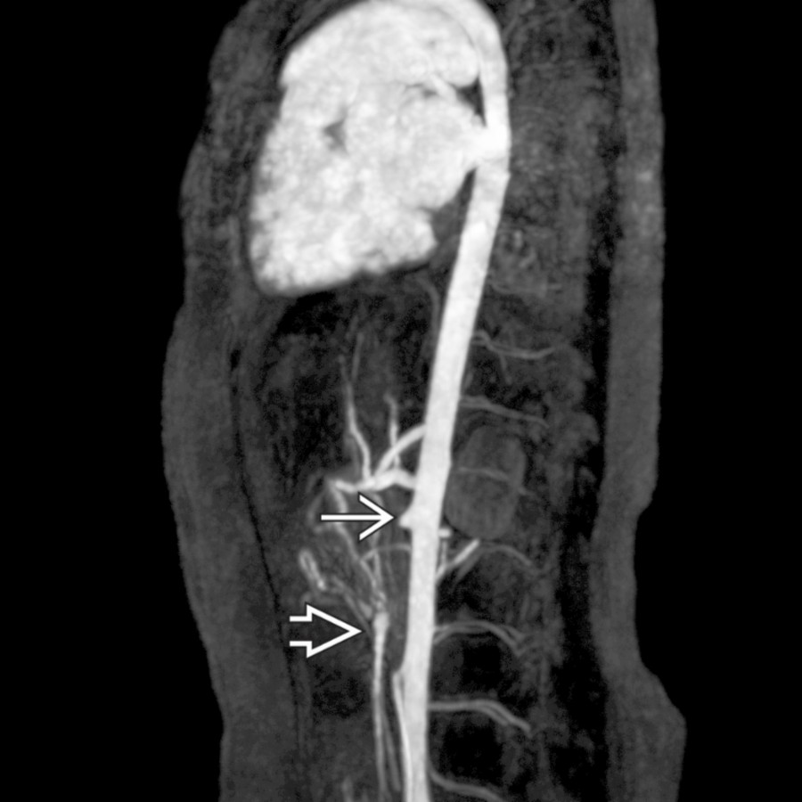 Coronal oblique contrast-enhanced MRA shows a diffusely narrowed aorta occlusion of the superior mesenteric artery . Note reconstituted SMA .
