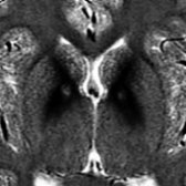 Axial T2WI MR in PKAN (Hallervorden-Spatz syndrome), the most common NBIA, shows classic eye of the tiger sign. Note globi pallidi (GP) hypointensity  due to iron deposition with central hyperintensity  due to neuronal loss, gliosis, & cavitation of neuropil. The central T2 hyperintensity can be predominant MR finding initially with surrounding GP T2 hypointensity developing later.