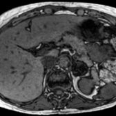 Axial out-of-phase T1 MR in the same patient shows diffuse signal loss in the left adrenal mass , consistent with intracytoplasmic lipid in an adrenal adenoma. The mass remained stable over 4 years since incidental detection on initial surveillance imaging.