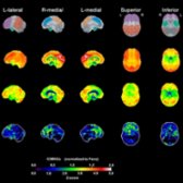PET scan in the same patient was performed. Stereotaxic surface projections show normal glucose metabolism in age-matched controls (2nd row). The patient's scan (3rd row) shows multifocal cortical areas of decreased glucose metabolism. Z-scores are shown on the bottom row. (Courtesy N. Foster, MD.)