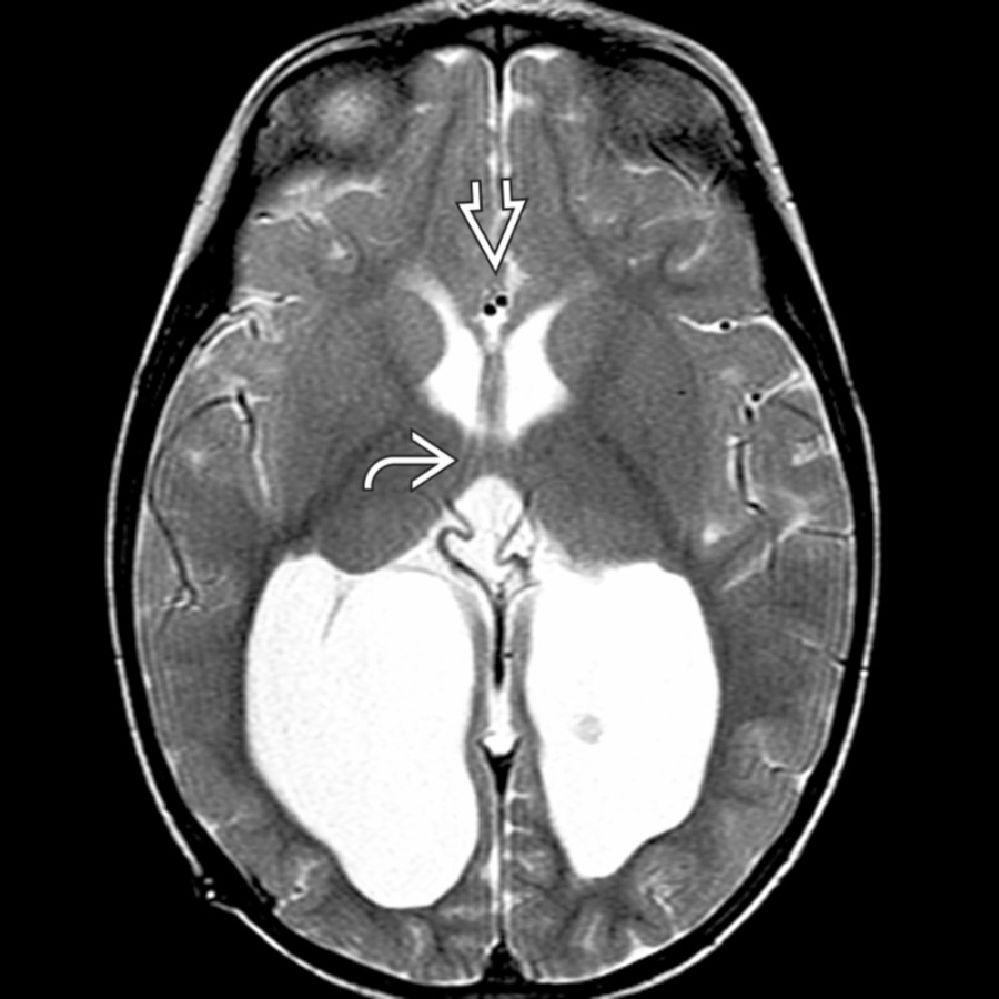Axial T2 MR shows a prominent massa intermedia  & colpocephalic lateral ventricles with periventricular white matter deficiency in Chiari 2. The genu  of the corpus callosum, usually seen on axial images, is absent.