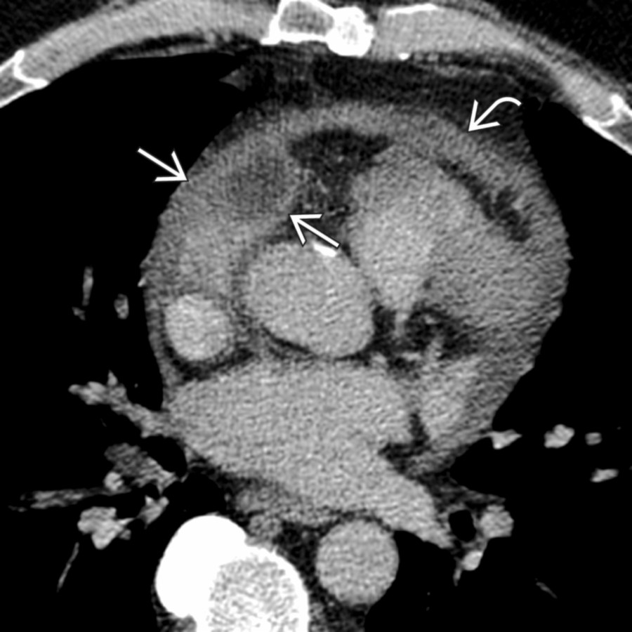 Axial CECT in a patient with a pericardial abscess shows a fluid collection adjacent to the right atrial appendage . The collection has thick, enhancing walls, and there is associated pericardial thickening  and inflammatory stranding.