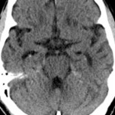 Axial NECT in a 82-year-old patient shows subtle calcifications in the region of the hippocampal formations bilaterally .