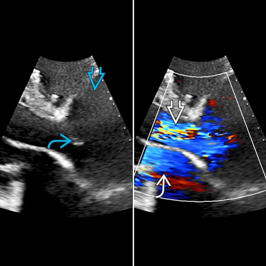 Coned down 3-chamber echocardiogram in a 36-year-old with Marfan syndrome shows balloon-like dilation of the AA  above the aortic valve . During diastole, there is severe aortic regurgitation  with flow paralleling adjacent mitral inflow .