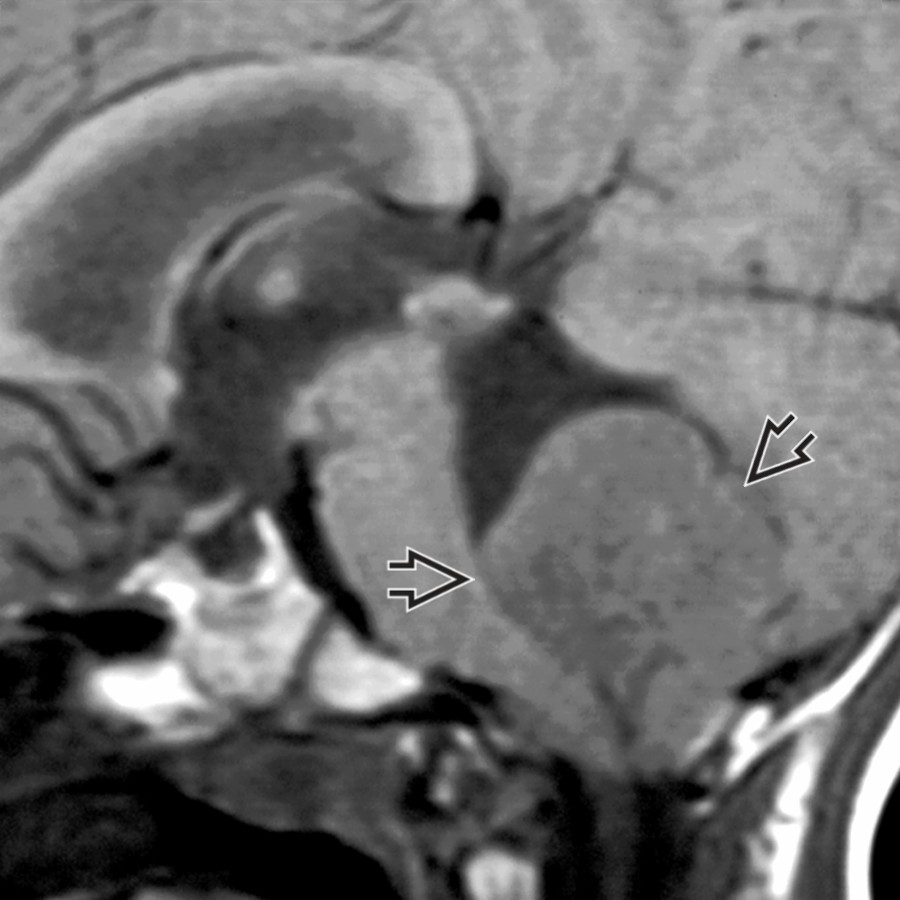 Sagittal T1WI MR shows large mass within the 4th ventricle  causing IVOH or noncommunicating hydrocephalus.