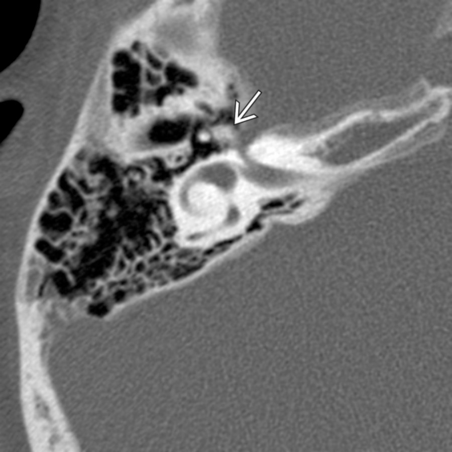 Axial bone CT shows healing bone fragments in the lateral geniculate fossa . This patient suffered temporal bone fracture with persistent facial nerve paralysis 6 weeks before this CT.
