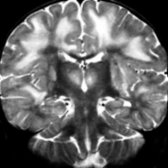 Coronal T2 MR shows large, confluent regions of hyperintense signal in the WM   and deep gray nuclei  of a child with ADEM. Although ADEM predominantly involves WM, gray matter is often affected.