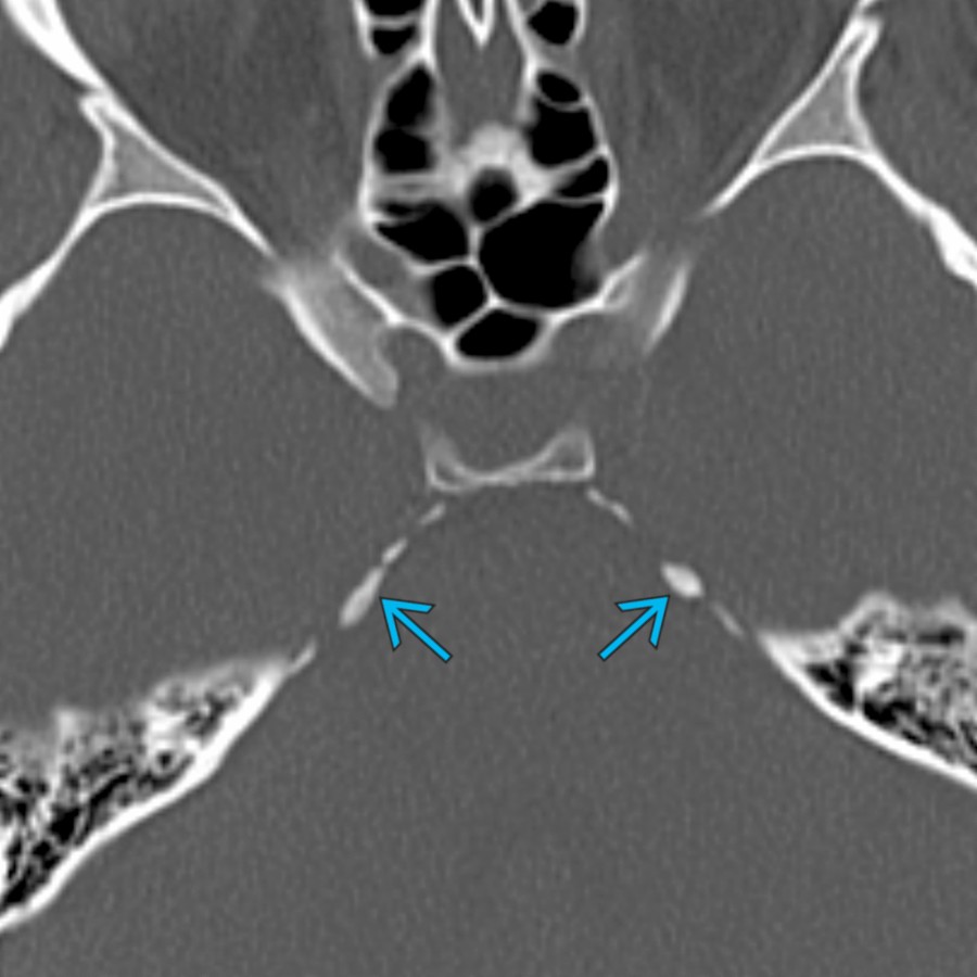 Axial NECT bone window shows dural calcifications  along the petroclinoid ligaments. Although typically physiologic, multiple dural calcifications may also be seen in basal cell nevus syndrome.