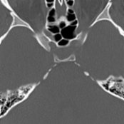 Axial NECT bone window shows dural calcifications  along the petroclinoid ligaments. Although typically physiologic, multiple dural calcifications may also be seen in basal cell nevus syndrome.