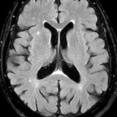 Axial FLAIR MR in a 78-year-old man shows prominence of the ventricles & sulci due to age-related volume loss. Smooth, thin, periventricular hyperintense rim   & subtle hyperintensity in the splenium  of corpus callosum is common & normal. In addition, there are few white matter FLAIR hyperintensities .