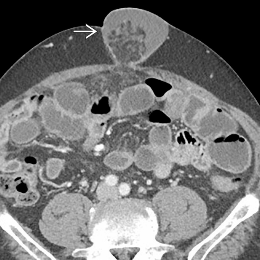 Axial CECT demonstrates an umbilical hernia  filled with ascites fluid in this patient with cirrhosis. Umbilical hernias frequently fill with fluid in cirrhotic patients with tense ascites due to portal hypertension.