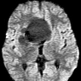 Axial DWI MR in the same patient with a large craniopharyngioma shows no restriction in the fluid-containing part of the tumor .