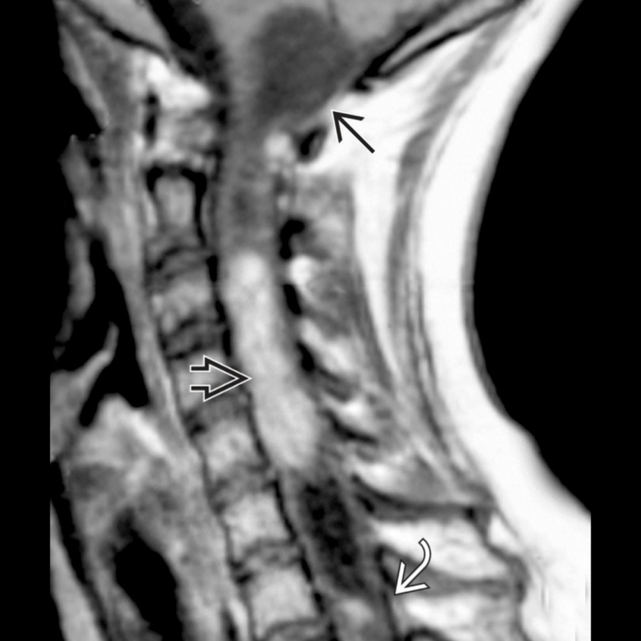 Sagittal T1 C+ MR shows an enhancing intraaxial mass  with rostral and caudal syrinx and a satellite lesion  enlarging the cervical cord. Note severe syringobulbia .