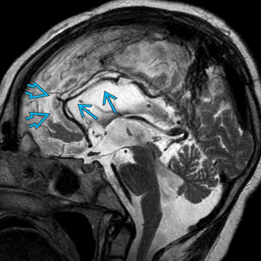 Midline sagittal T2 MR in an 11 year old with intractable epilepsy who had undergone an isolated corpus callosotomy shows absence of the corpus callosum  but presence of a cingulate gyrus . The presence of a cingulate gyrus would not be expected with congenital agenesis of the corpus callosum.