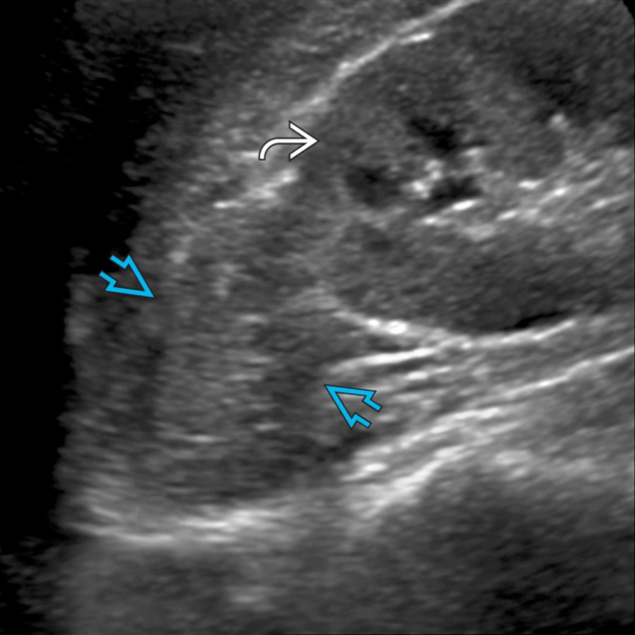 Longitudinal transabdominal ultrasound shows a large left adrenal mass , slightly heterogeneous and hypoechoic to the renal cortex .