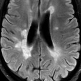 Axial FLAIR MR 3T shows multiple nonenhancing, periventricular, hyperintense MS lesions oriented perpendicular to the callosomarginal interface. These lesions are perivenular, along the path of the deep medullary veins, and represent "Dawson fingers." Confluent lesions are also seen along the right periventricular margin.